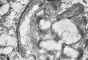 F,22y. | Pindborg tumor F,22y. | Pindborg tumor